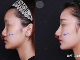 克拉克松（一致凸和严格凸的区别？）