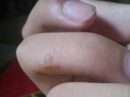 泡否，油溅伤起了泡要弄开吗？