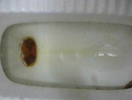 太深了好涨尿进来了（尿颜色深是什么情况？）