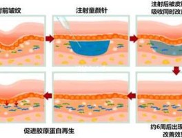 美黛拉（童颜针怎么溶解掉？）