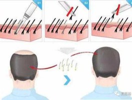 植发（植发是怎样的步骤？）