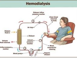 肾透析概念股 肾透析临时插管在什么位置？