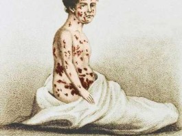天花疫苗上市公司，古代的天花，现在叫什么？